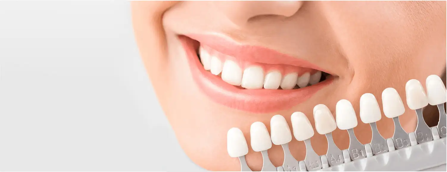 Які є види вінірів?